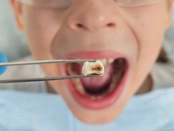 Best Emergency Tooth Extraction in California, MD